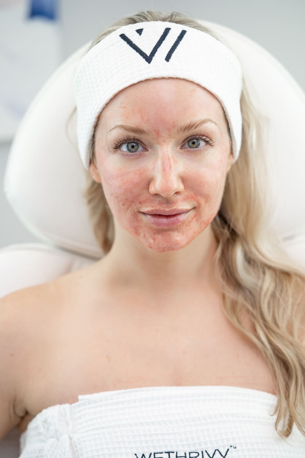 maskad-before